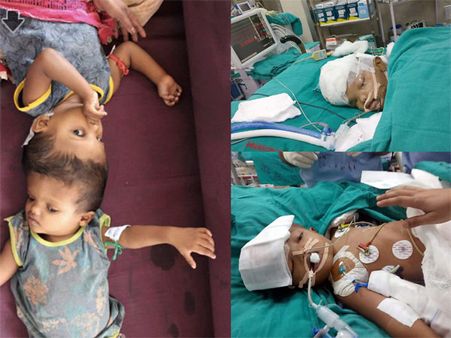 Odisha twins joined at head separated after 16 hour long surgery