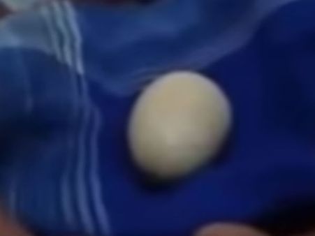 This Indonesian boy laid 20 eggs in two years; leaves doctors baffled