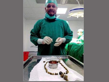 Doctors remove 99 stones from woman’s gallbladder in Karnataka