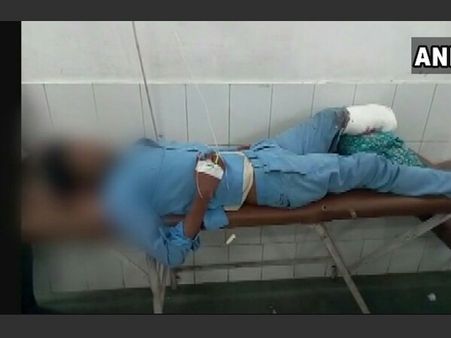 UP shocker: Jhansi doctors use amputated leg as pillow, probe ordered