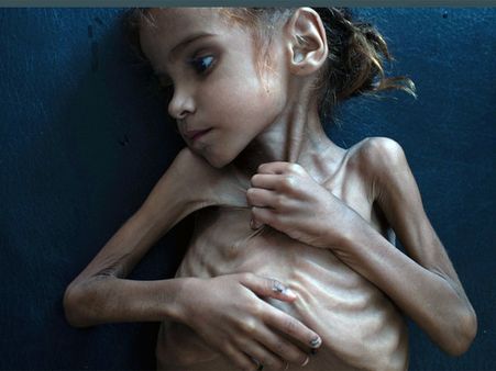 Death of Amal Hussain, malnourished Yemeni girl, brings back haunted memory of Aylan Kurd