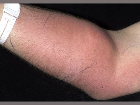 Ireland man injects himself with own semen to get rid of back pain; hospitalised