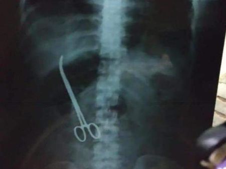 Woman in whose abdomen a scissor was left after surgery stable now