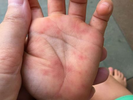 New study reveals that skin diseases more prevalent than thought