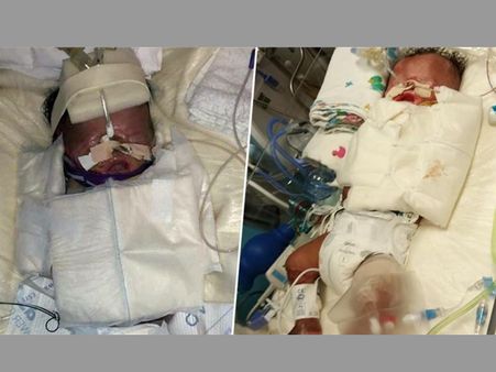 Premature baby born without skin defies the odds to survive