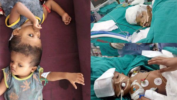 After 50 hours of surgery, conjoined twins joined at skull, successfully separated