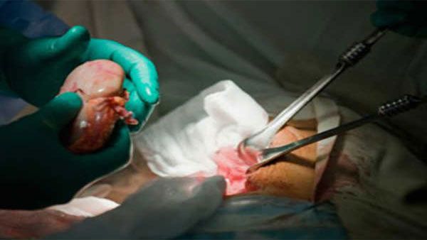 Doctors remove world's largest kidney weighing 7.4 kg at hospital