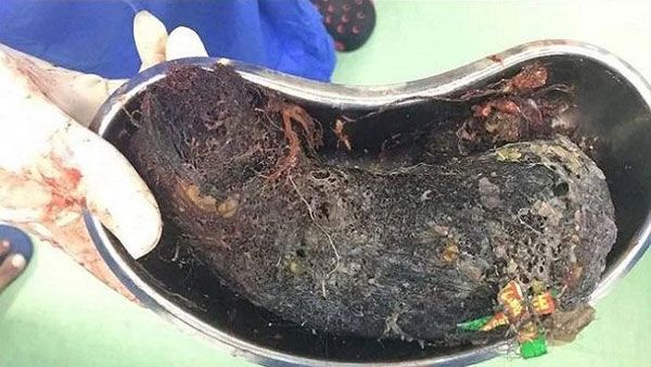 Half kg human hair, shampoo packets removed from 13-year-old girl's stomach in Tamil Nadu