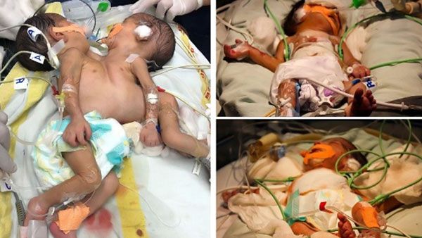 Twins conjoined in the chest, abdomen successfully separated after 4 hours of surgery