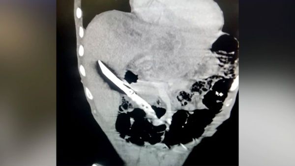 Rare surgery: 20-cm knife removed from 28-year-old man’s liver