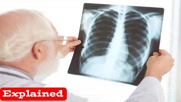 Explained: Researchers show how chest X-rays help in diagnosis of COVID-19