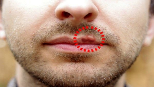 Recovered from Covid-19? Now, watch out for these signs of skin symptom