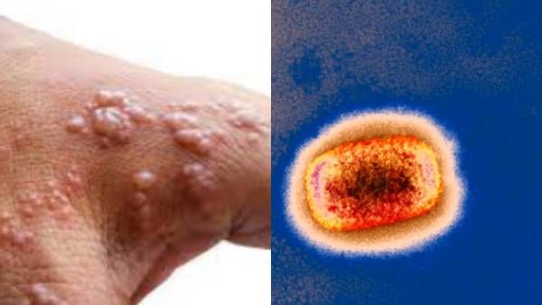 Countries should take quick steps to contain spread of monkeypox, says WHO