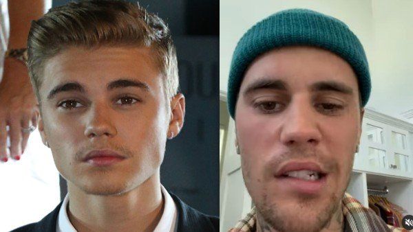 What is Ramsay Hunt syndrome? the condition affecting the Justin Bieber