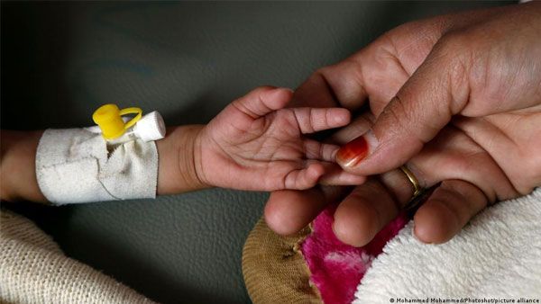 UNICEF: 8 million kids at risk of dying from malnutrition