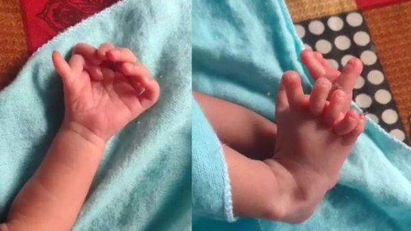 Baby Girl Born With 26 Fingers And Toes In Rajasthan, Family Believes She Is A Miracle