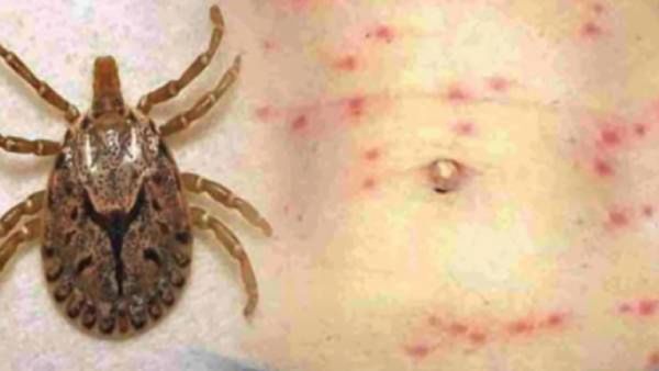 Scrub Typhus: The Deadly Disease Striking Lives In India