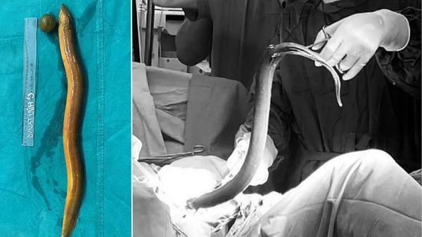 Indian Man In Vietnam Inserts Live Eel Into Anus, Gets His Colon Eaten By It; Docs Find Lemon Inside Too