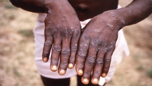 What Is Mpox (Monkeypox)? How Does It Spread? Find Out Here