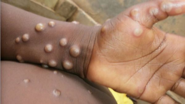 Rising Mpox Cases In African Countries Raises Health Concerns Worldwide