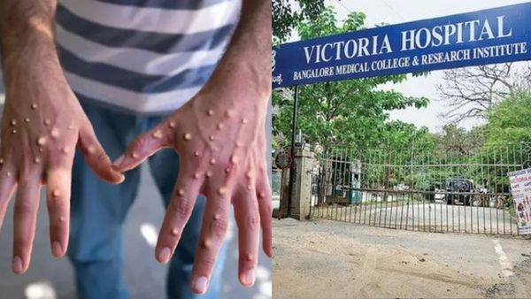 Bengaluru: Victoria Hospital Reports First Suspected Monkeypox Case
