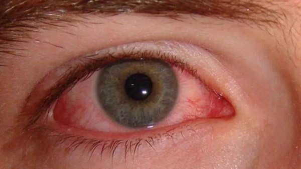 Pink Eye Infection Returns in Bengaluru, Raising Concerns Among Parents and Doctors