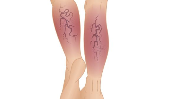 What Is Chronic Venous Insufficiency (CVI)?