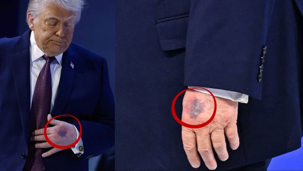 Disturbing Burn Mark Or Disease? Donald Trump Appears With Visible Bruising On Both Hands In Davos Event