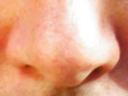 ಕೋಪದ ಆವೇಶದಲ್ಲಿ ಕುಯ್ದುಕೊಂಡ ಮೂಗು