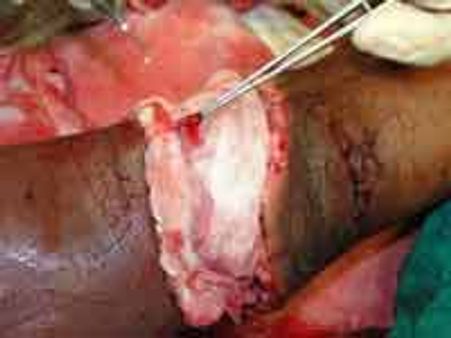 ವಿಮ್ಸ್ ವೈದ್ಯರ ಸಾಧನೆ ಮುಂಗೈ ಮರುಜೋಡಣೆ