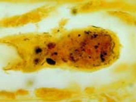 ವಿಚಿತ್ರ ಜ್ವರಕ್ಕೆ ಬೆಚ್ಚಿಬಿದ್ದ ಬಳ್ಳಾರಿ ಜಿಲ್ಲೆ