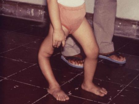 ಜ. 18, 22ರಂದು ಮಕ್ಕಳಿಗೆ ಮರೆಯದೆ ಪೋಲಿಯೋ ಹಾಕಿಸಿ