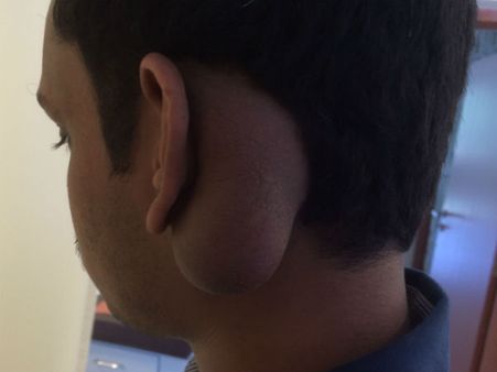 10 ಸೆಂಮೀ ಟ್ಯೂಮರ್ ಹೊರತೆಗೆದ ಮಾರ್ಥಾಸ್ ವೈದ್ಯರು!