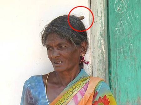 ಅಚ್ಚರಿ : ಚಾಮರಾಜನಗರದ ಮಹಿಳೆ ತಲೆಯಲ್ಲಿ ಕೊಂಬು!