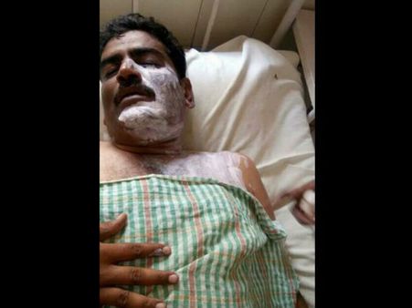 ಗುಂಡ್ಲುಪೇಟೆ: ಗ್ರಾಪಂ ಸದಸ್ಯನ ಮೇಲೆ ಆ್ಯಸಿಡ್ ದಾಳಿ