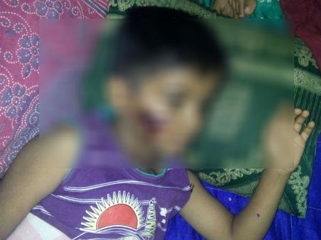 ಬೀದಿ ನಾಯಿ ದಾಳಿಗೆ ತುತ್ತಾಗಿದ್ದ ಬಾಲಕ ಸಾವು