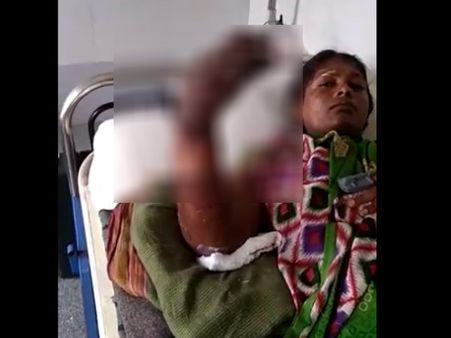 ಖಾಸಗಿ ವೈದ್ಯೆಯ ಯಡವಟ್ಟಿನಿಂದ ಬಲಗೈ ಕಳೆದುಕೊಂಡ ಗರ್ಭಿಣಿ