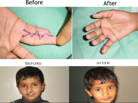 ಮಲ್ಲೇಶ್ವರದ ಆಸ್ಪತ್ರೆಯಲ್ಲಿ ಉಚಿತ ಪ್ಲಾಸ್ಟಿಕ್ ಸರ್ಜರಿ ಶಿಬಿರ