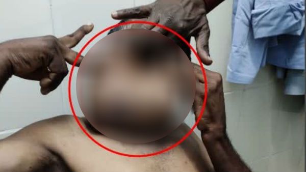 ವ್ಯಕ್ತಿಯ ಕುತ್ತಿಗೆಯ ಭಾಗದಲ್ಲಿ ಸ್ತನ; ವೈದ್ಯಲೋಕಕ್ಕೆ ಅಚ್ಚರಿ