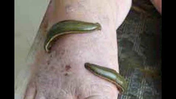 ಮಲೆನಾಡಿನಲ್ಲಿ ರಕ್ತ ಹೀರುವ ಜಿಗಣೆಗಳೇ ಜೀವ ರಕ್ಷಕರು!