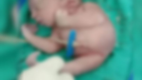 ಹುಬ್ಬಳ್ಳಿ: ಒಂದೇ ಕಾಲಿನ ಅಪರೂಪದ ಮಗು ಜನನ