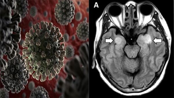 ಕೊರೊನಾ ಆಯ್ತು ಈಗ ಮನುಷ್ಯರ ಮಾಂಸ, ಮೆದುಳು ತಿನ್ನುವ ಹುಳುಗಳ ಕಾಟ..!