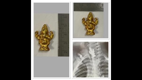 ಎಕ್ಸ್‌ರೇನಲ್ಲಿ ನೋಡಿ ಬಾಲಕನ ಹೊಟ್ಟೆಯಲ್ಲಿ ಗಣೇಶ ವಿಗ್ರಹ ಪತ್ತೆ !