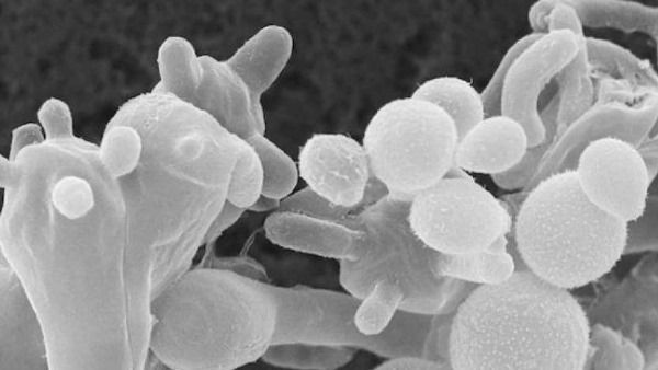 ಕೋವಿಡ್‌ನಿಂದ ಚೇತರಿಸಿದ ವ್ಯಕ್ತಿಯ ಮೆದುಳಿನಲ್ಲಿ ವೈಟ್‌ ಫಂಗಸ್‌ ಪತ್ತೆ