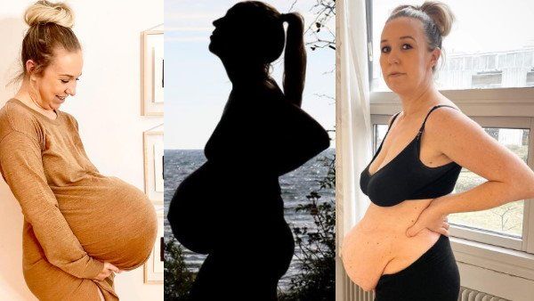 OMG! ಈ ಮಹಿಳೆಯ ಹೊಟ್ಟೆ ನೋಡಿ ಬೆಚ್ಚಿಬಿದ್ದ ನೆಟ್ಟಿಗರು