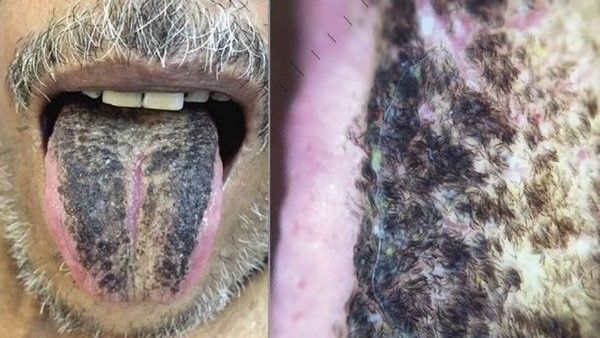 ವಿಶಿಷ್ಟ ಪ್ರಕರಣ: ಈ ರೋಗಲಕ್ಷಣಗಳಿದ್ದವರ ನಾಲಿಗೆ ಮೇಲೆ ಬೆಳೆಯುತ್ತೆ ಕೂದಲು