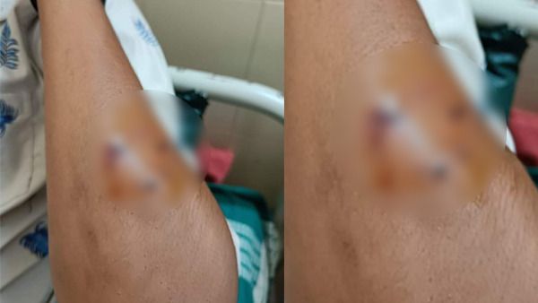 ಶಿವಮೊಗ್ಗ: ಪರೀಕ್ಷೆಯಲ್ಲಿ ಕಾಪಿ ಹೊಡೆಯುತ್ತಿದ್ದ ವಿದ್ಯಾರ್ಥಿಯ ಕೈ ಕಚ್ಚಿದ ಉಪನ್ಯಾಸಕ