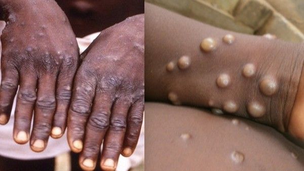 ಮಂಕಿಪಾಕ್ಸ್; 21-ದಿನ ಐಸಲೋಶನ್, ಮಾಸ್ಕ್ ಕಡ್ಡಾಯ, ಈ ರೋಗ ಪರಿಕ್ಷೆ ಎಲ್ಲಿ?