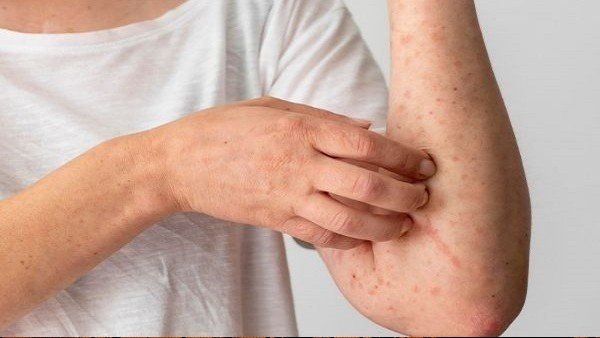 just in: ಮಹಾರಾಷ್ಟ್ರ; 10ರಲ್ಲಿ 9 ಮಂಕಿಫಾಕ್ಸ್ ಪ್ರಕರಣಗಳು ನೆಗಟಿವ್