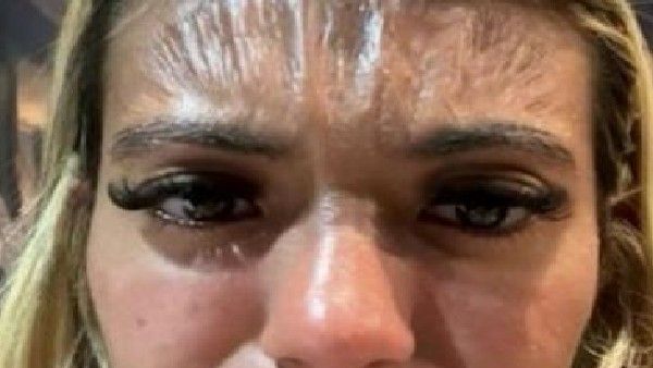 Shocking: ಬಿಸಿಲಿನಲ್ಲಿ ಮಲಗಿದ್ದರ ಎಫೆಕ್ಟ್; ಪ್ಲಾಸ್ಟಿಕ್‌ನಂತಾದ ಚರ್ಮ- ಹೌಹಾರಿದ ಯುವತಿ